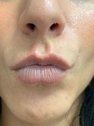 Injectables Minimally-Invasive / Fillers: Case 19 (21274) - Before