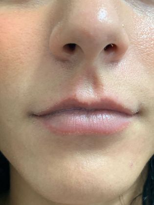 Injectables Minimally-Invasive / Fillers: Case 19 (21274) - Before