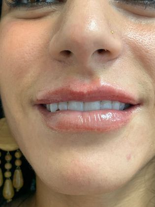 Injectables Minimally-Invasive / Fillers: Case 19 (21274) - Immediately after treatment