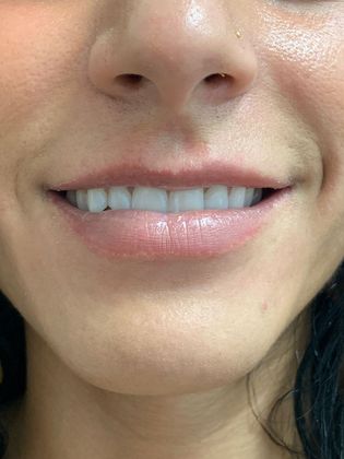 Injectables Minimally-Invasive / Fillers: Case 19 (21274) - Before