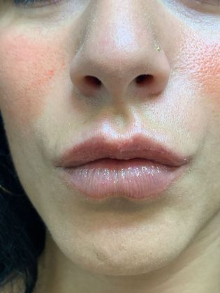 Injectables Minimally-Invasive / Fillers: Case 19 (21274) - After