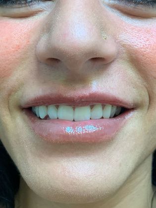 Injectables Minimally-Invasive / Fillers: Case 19 (21274) - After