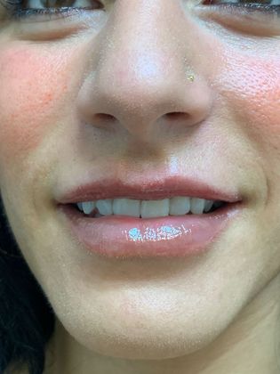 Injectables Minimally-Invasive / Fillers: Case 19 (21274) - After swelling gone