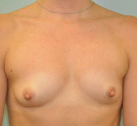 Breast Augmentation: Case 26 - Breast Implants, Orange - Before