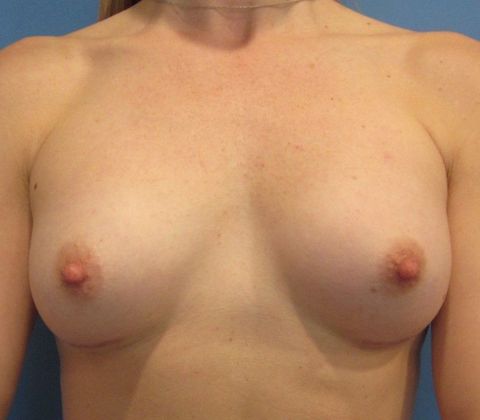 Breast Augmentation: Case 26 - Breast Implants, Orange - After