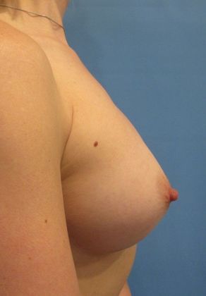 Breast Augmentation: Case 26 - Breast Implants, Orange - After