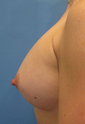 Breast Augmentation: Case 26 - Breast Implants, Orange - After