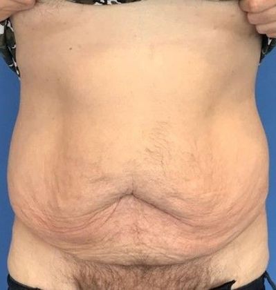 Tummy Tuck: Case 18 - Tummy Tuck, Norwalk, CT - Before