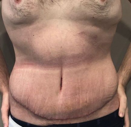 Tummy Tuck: Case 18 - Tummy Tuck, Norwalk, CT - After