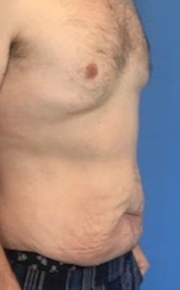 Tummy Tuck: Case 18 - Tummy Tuck, Norwalk, CT - Before