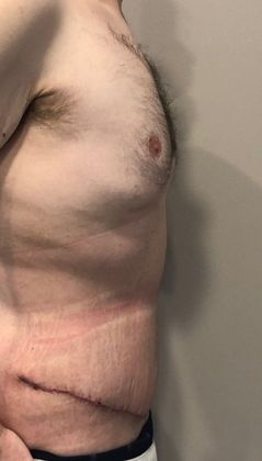 Tummy Tuck: Case 18 - Tummy Tuck, Norwalk, CT - After