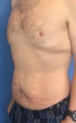 Tummy Tuck: Case 18 - Tummy Tuck, Norwalk, CT - Before