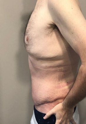 Tummy Tuck: Case 18 - Tummy Tuck, Norwalk, CT - After