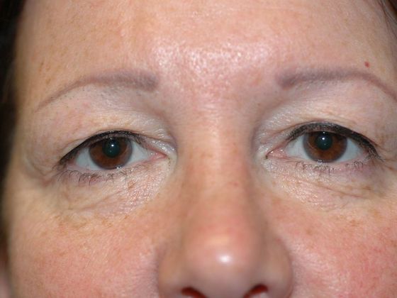 Eyelid Surgery: Case 5 - Noblesville - Before