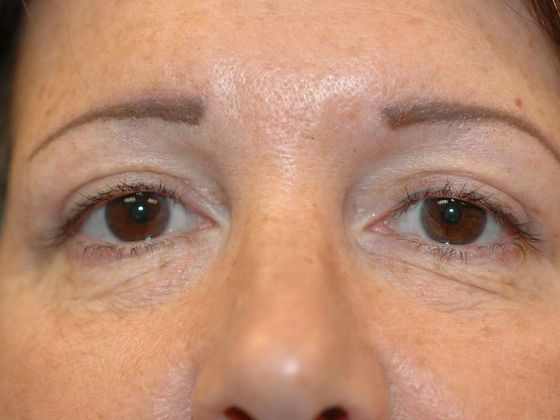 Eyelid Surgery: Case 5 - Noblesville - After