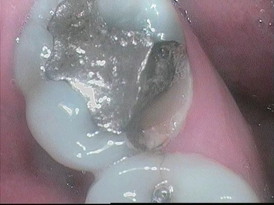 White Fillings: Case 8 Replacing Silver Fillings - Before