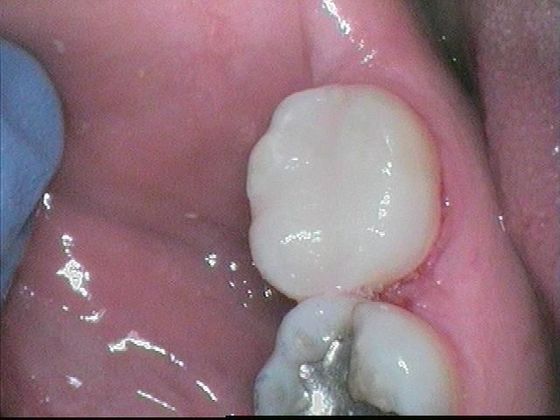 White Fillings: Case 8 Replacing Silver Fillings - After