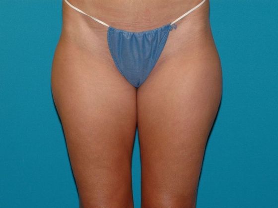 Liposuction Case 14 - Bloomington - Before