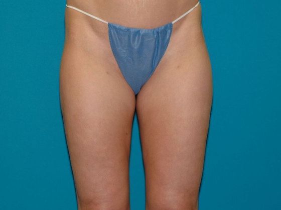 Liposuction Case 14 - Bloomington - After