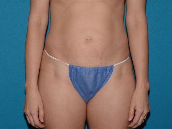 Liposuction: Case 15 - Noblesville - After