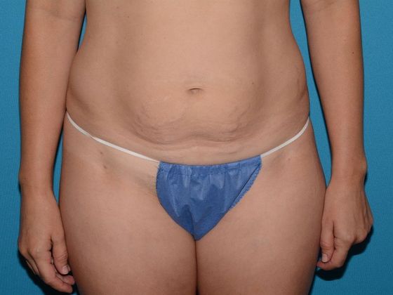 Liposuction: Case 15 - Noblesville - Before