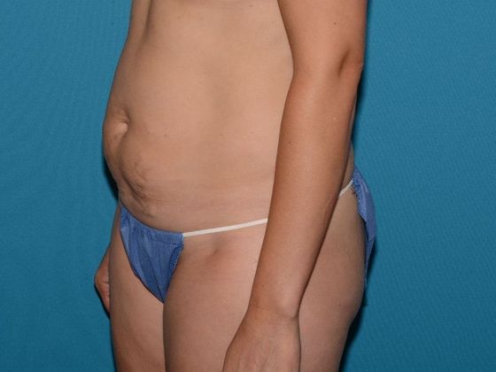 Liposuction: Case 15 - Noblesville - Before