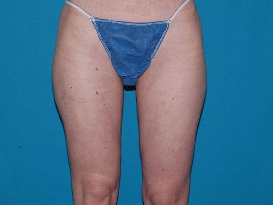 Liposuction: Case 16 - Avon - After