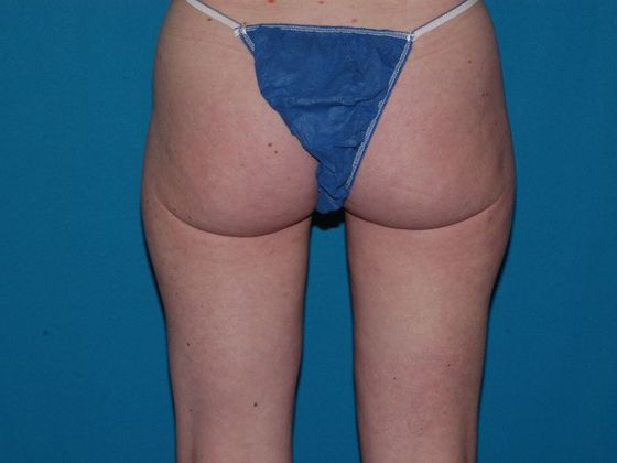 Liposuction: Case 16 - Avon - After