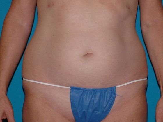 Liposuction: Case 17 - Anderson - Before