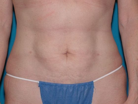 Liposuction: Case 17 - Anderson - After