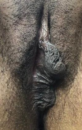 Labiaplasty Case 17 - Labiaplasty, Bridgeport, CT - Before