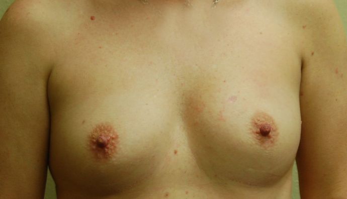 Breast Augmentation Case 567 - Before