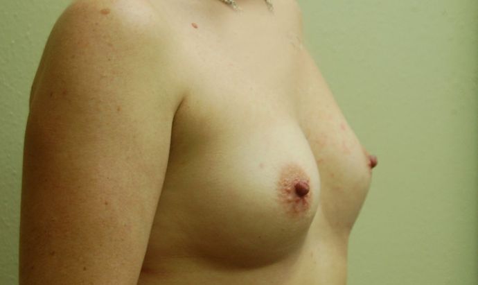 Breast Augmentation: Case 567 - Before
