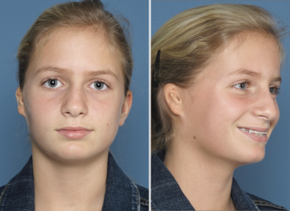 Combined Ear & Canal: Before & After - BEFORE & AFTER 10yr. old girl seen before & 3 yrs. after combined ear & canal surgery.
