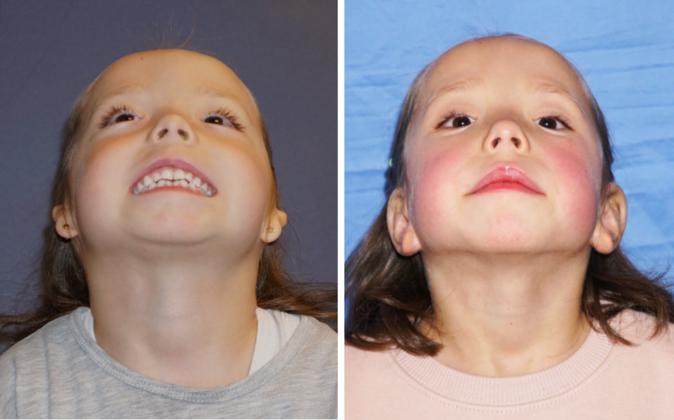 4 year old Mexican girl with microtia seen before & after right & left surgeries.