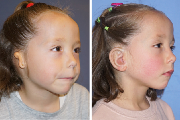 Both Ears: Before & After - BEFORE & AFTER 4yr old girl after combined ear & canal reconstruction of both ears