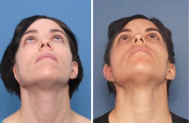 Correcting Prior Surgeries Patient 4 - Before