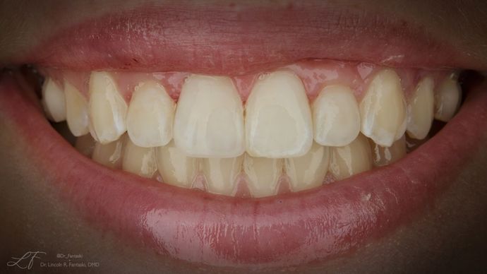 Dental Bonding - Teeth Bonding  Case 2 Chipped and Broken Tooth - Accident Dental - After