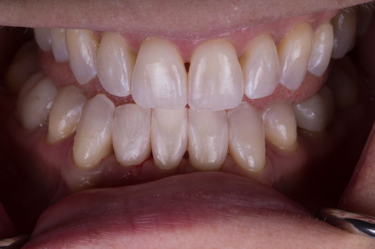 Lower Anterior Bonding Dental Bonding Teeth Bonding Before and