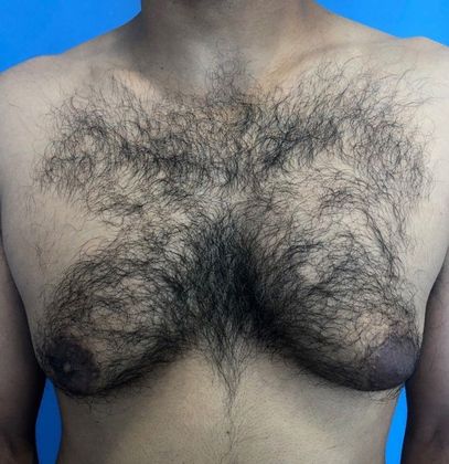 Male Breast Reduction Case 3 Gynecomastia Redding, CT - Before