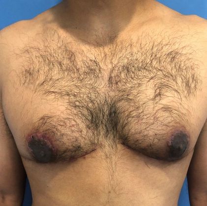 Male Breast Reduction Case 3 Gynecomastia Redding, CT - After
