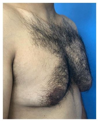 Male Breast Reduction: Case 3 Gynecomastia Redding, CT - Before