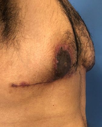 Male Breast Reduction: Case 3 Gynecomastia Redding, CT - After