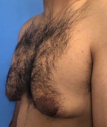 Male Breast Reduction: Case 3 Gynecomastia Redding, CT - Before