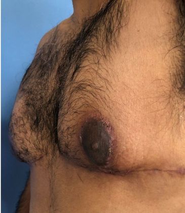 Male Breast Reduction: Case 3 Gynecomastia Redding, CT - After