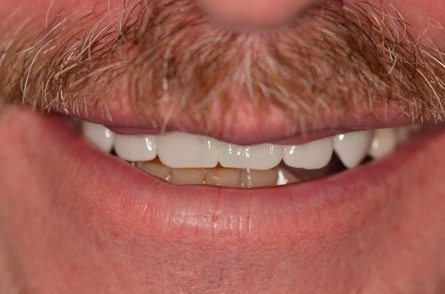 Bridges: Case 4 - After