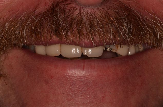 Bridges: Case 4 - Before