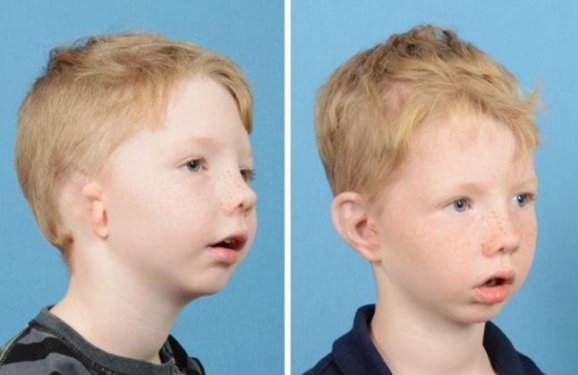 Before & after right ear reconstruction.