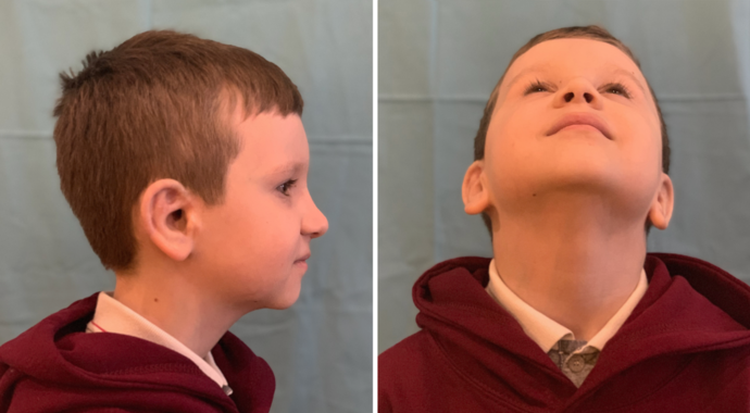 Boy seen 4 years & 4.5 years after left & right ear reconstruction surgeries.
