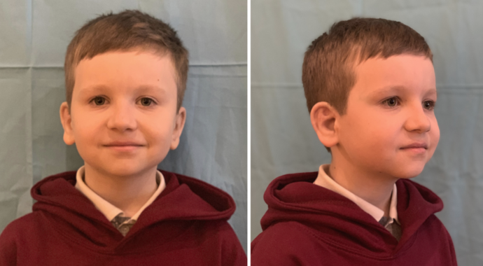 Boy seen 4 years & 4.5 years after left & right ear reconstruction surgeries.